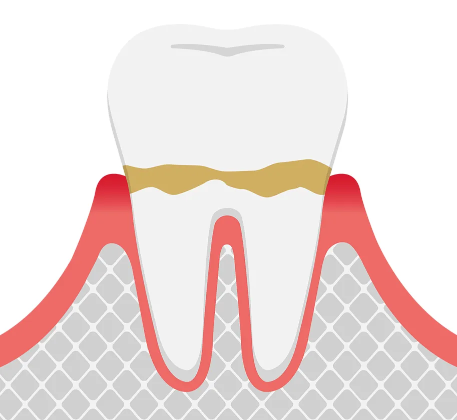 歯肉炎