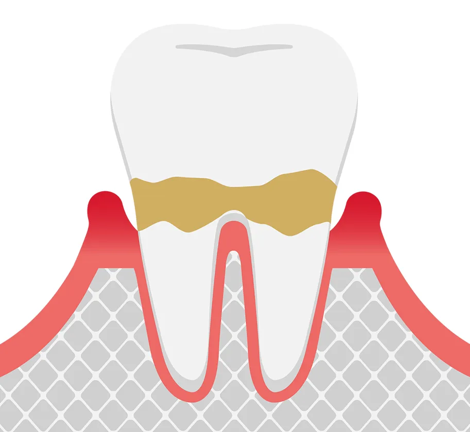 歯周炎（軽度）