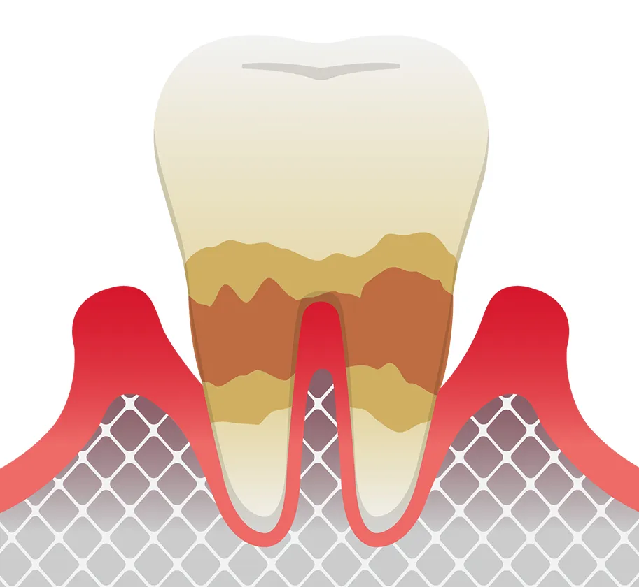 歯周炎（中度）